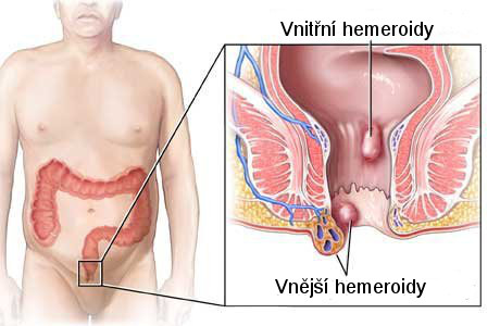 Vnitřní hemeroidy a Vnější hemeroidy 